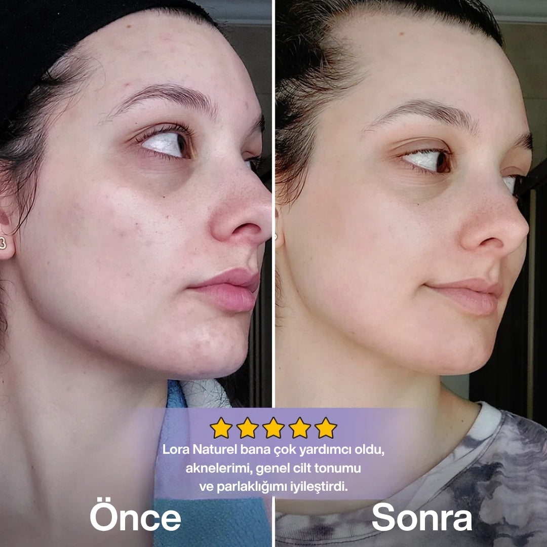 Lora Naturel™ %100 Vegan Buz Terapi Paketi