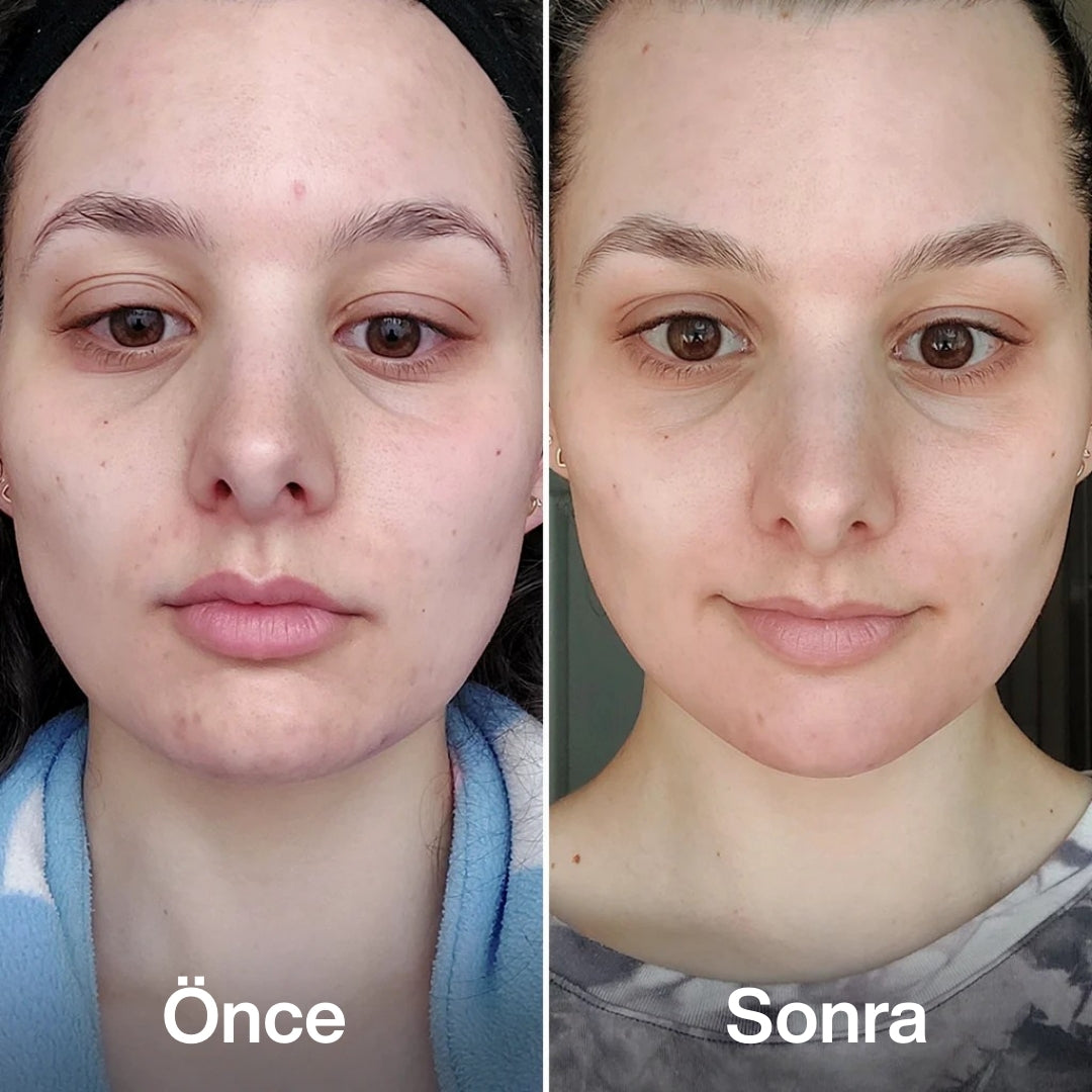 Lora Naturel™ %100 Vegan Buz Terapi Paketi
